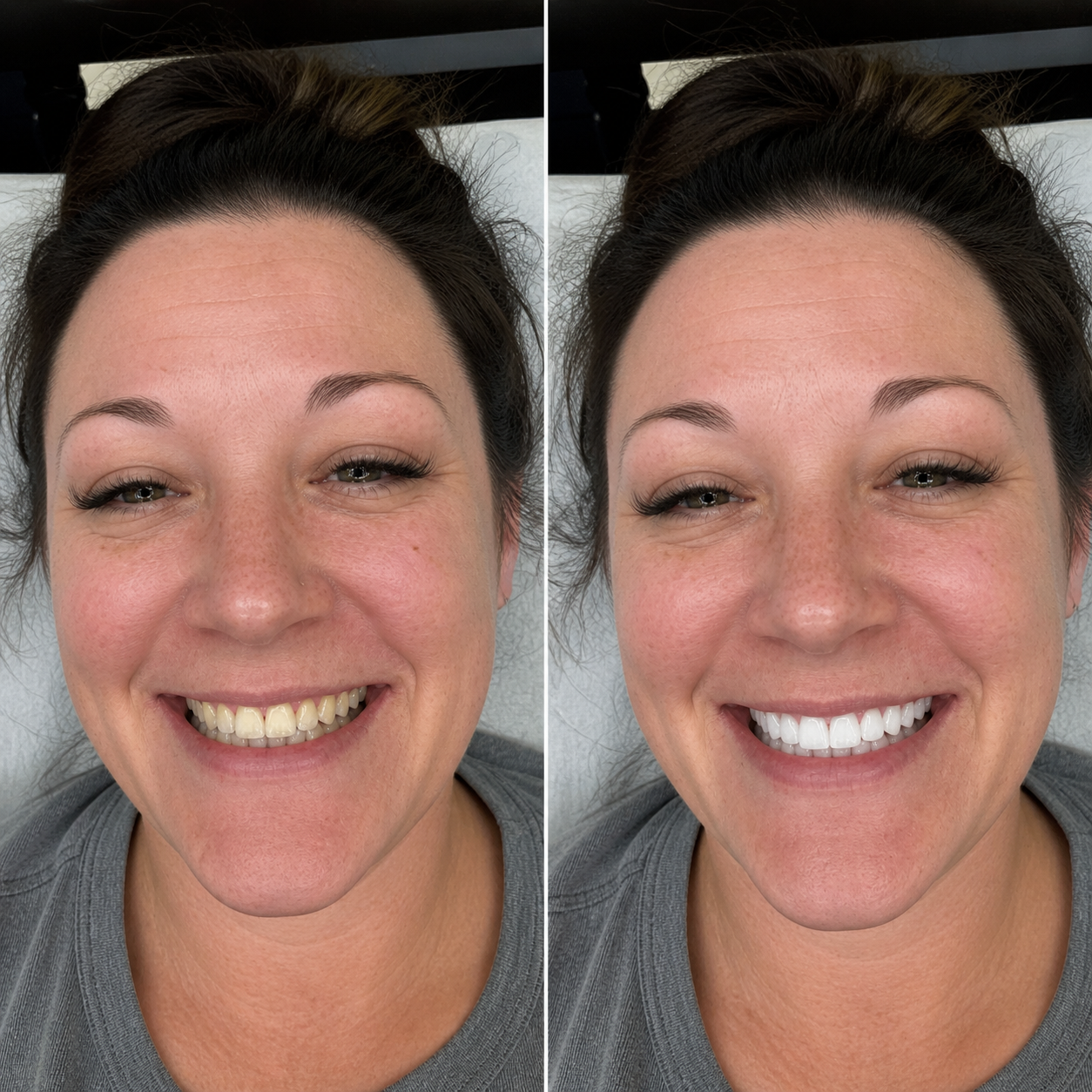 Before and after teeth whitening results